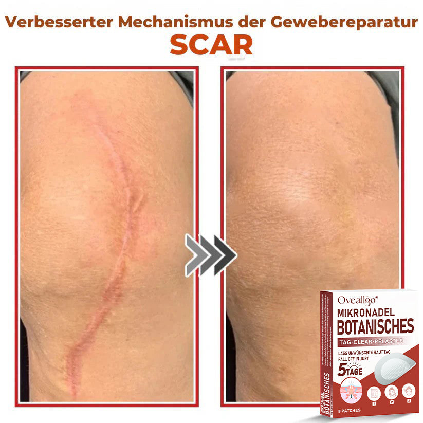 Oveallgo® MikroNadel PLUS Botanisches Tag-Clear-Pflaster 🇩🇪 Hergestellt in der Germany