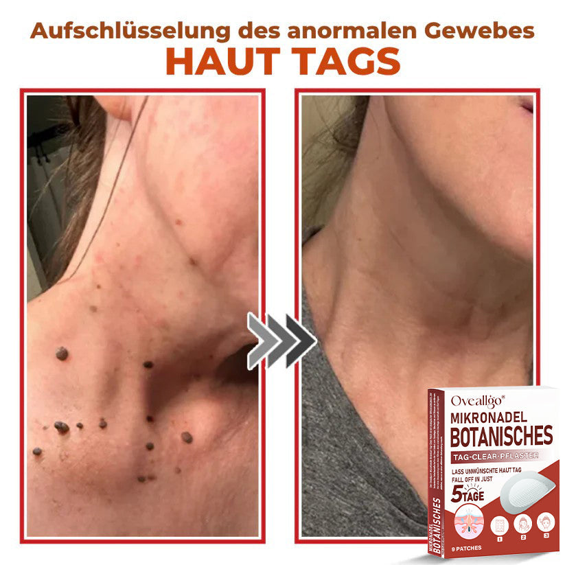 Oveallgo® MikroNadel PLUS Botanisches Tag-Clear-Pflaster 🇩🇪 Hergestellt in der Germany