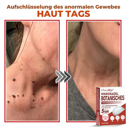 Oveallgo® MikroNadel PLUS Botanisches Tag-Clear-Pflaster 🇩🇪 Hergestellt in der Germany