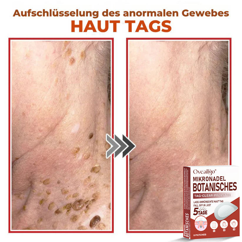 Oveallgo® MikroNadel PLUS Botanisches Tag-Clear-Pflaster 🇩🇪 Hergestellt in der Germany