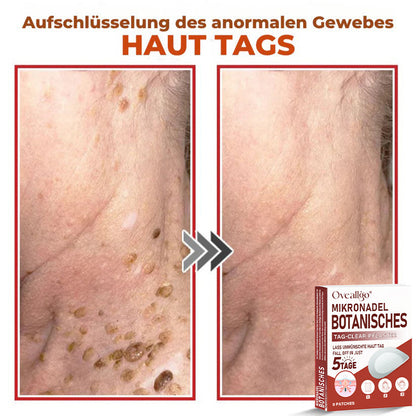 Oveallgo® MikroNadel PLUS Botanisches Tag-Clear-Pflaster 🇩🇪 Hergestellt in der Germany