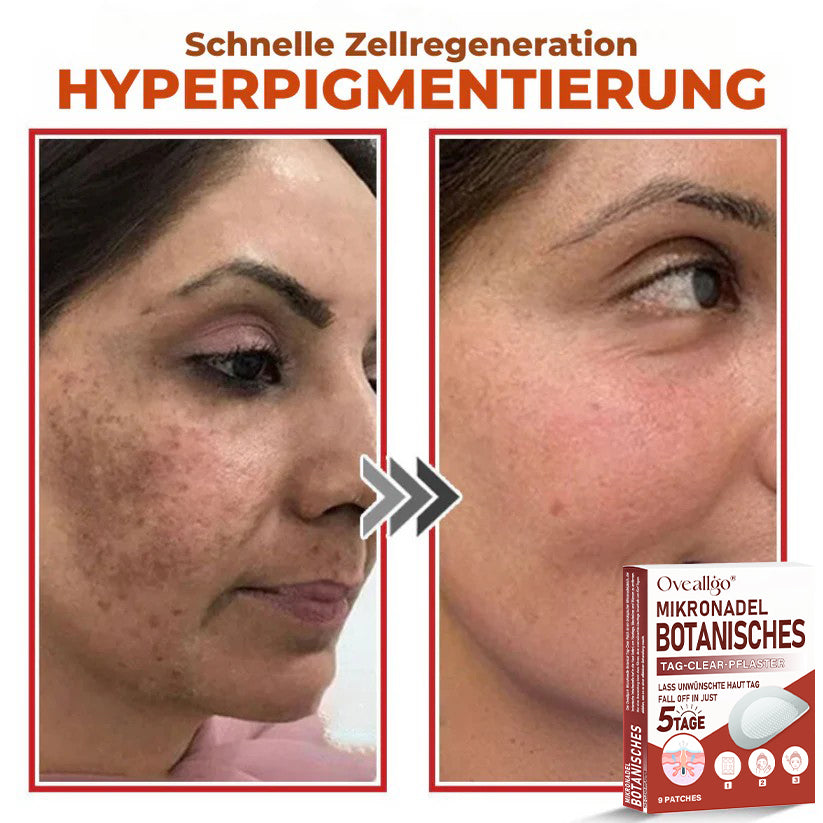 Oveallgo® MikroNadel PLUS Botanisches Tag-Clear-Pflaster 🇩🇪 Hergestellt in der Germany