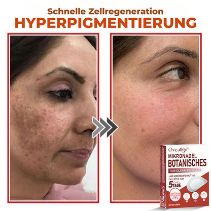 Oveallgo® MikroNadel PLUS Botanisches Tag-Clear-Pflaster 🇩🇪 Hergestellt in der Germany