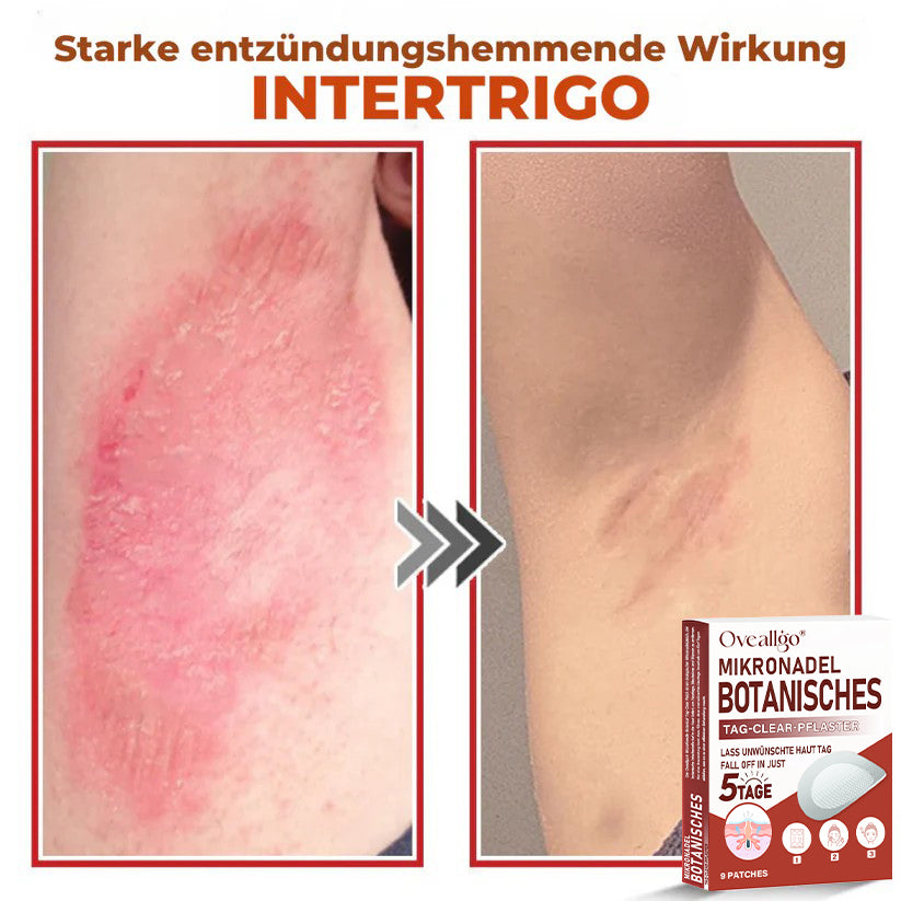 Oveallgo® MikroNadel PLUS Botanisches Tag-Clear-Pflaster 🇩🇪 Hergestellt in der Germany