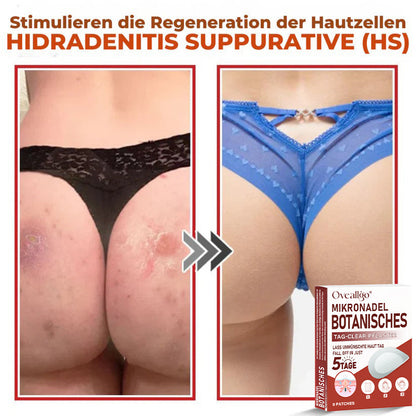 Oveallgo® MikroNadel PLUS Botanisches Tag-Clear-Pflaster 🇩🇪 Hergestellt in der Germany