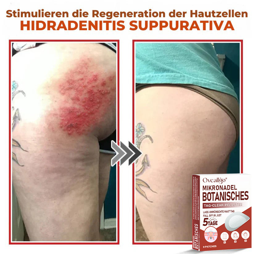 Oveallgo® MikroNadel PLUS Botanisches Tag-Clear-Pflaster 🇩🇪 Hergestellt in der Germany