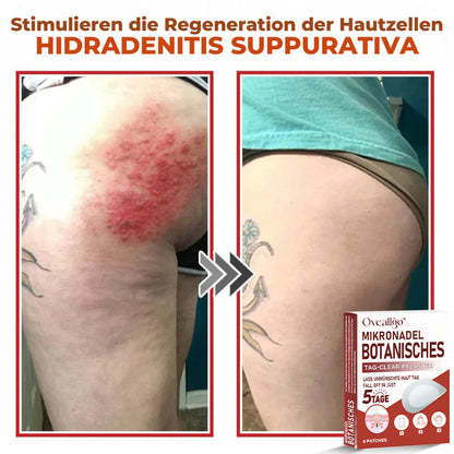 Oveallgo® MikroNadel PLUS Botanisches Tag-Clear-Pflaster 🇩🇪 Hergestellt in der Germany