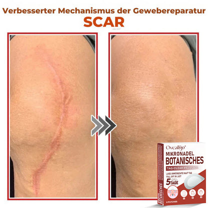 Oveallgo® MikroNadel PLUS Botanisches Tag-Clear-Pflaster 🇩🇪 Hergestellt in der Germany